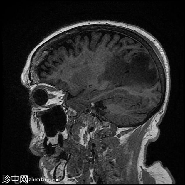 导管周围实质内囊肿