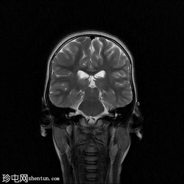 骨化性迷路炎