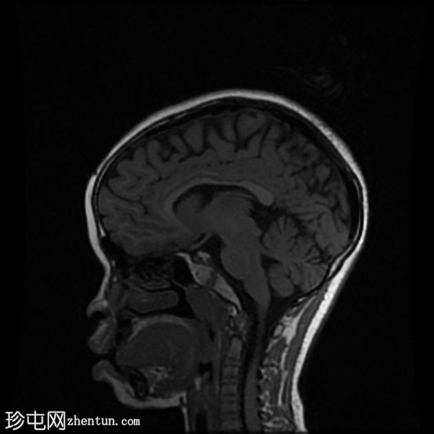 骨化性迷路炎