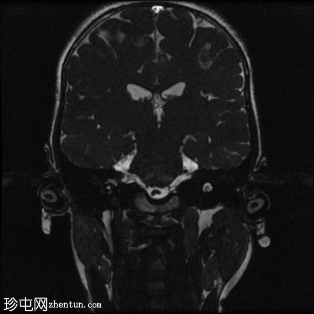 骨化性迷路炎