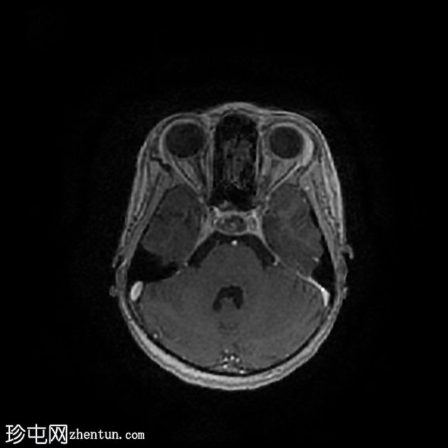 骨化性迷路炎