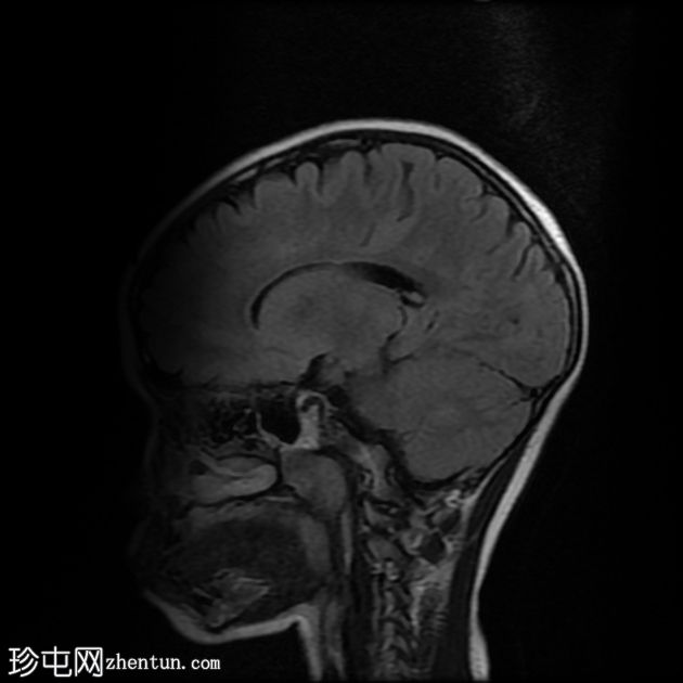 骨化性迷路炎