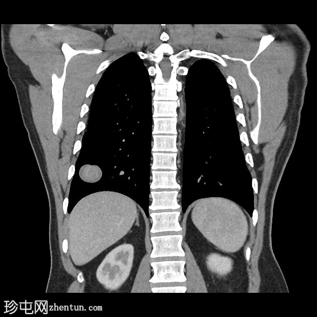 原发性肺脑膜瘤