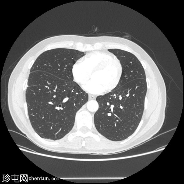 IgG-4 相关肺疾病