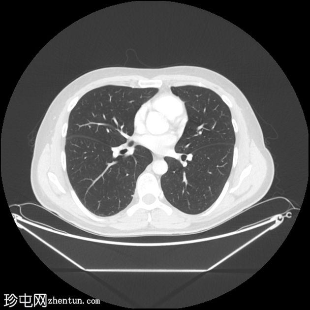 IgG-4 相关肺疾病