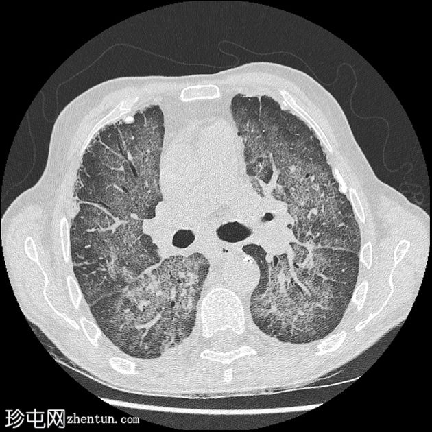 耶氏肺孢子虫肺炎 (PJP)