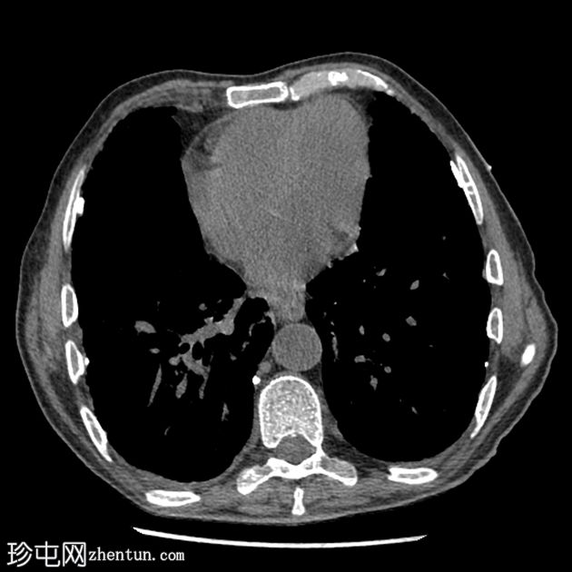 耶氏肺孢子虫肺炎 (PJP)