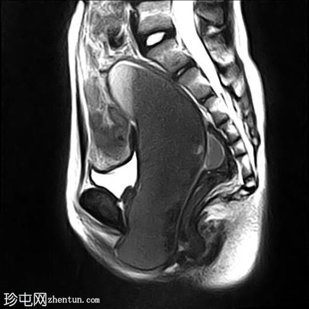 处女膜闭锁导致阴道积血