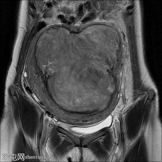 大型子宫平滑肌瘤伴有红色变性