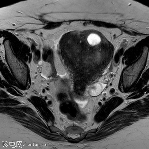 子宫囊性子宫腺肌病