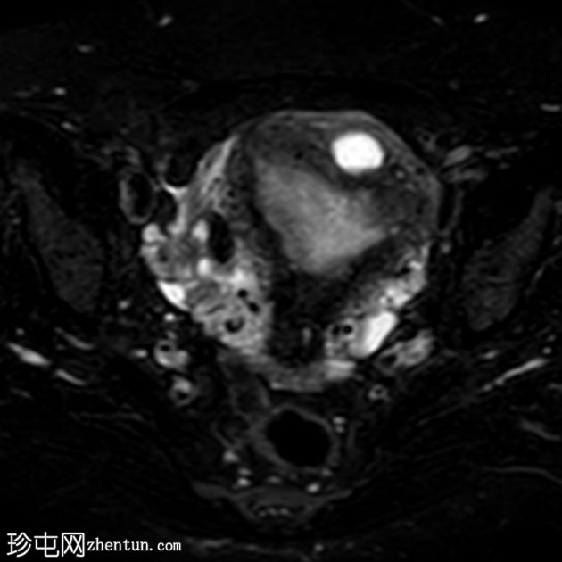 子宫囊性子宫腺肌病