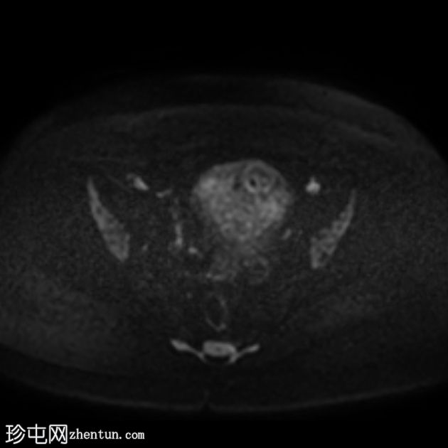 子宫囊性子宫腺肌病