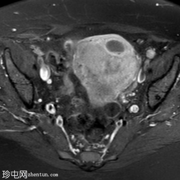 子宫囊性子宫腺肌病