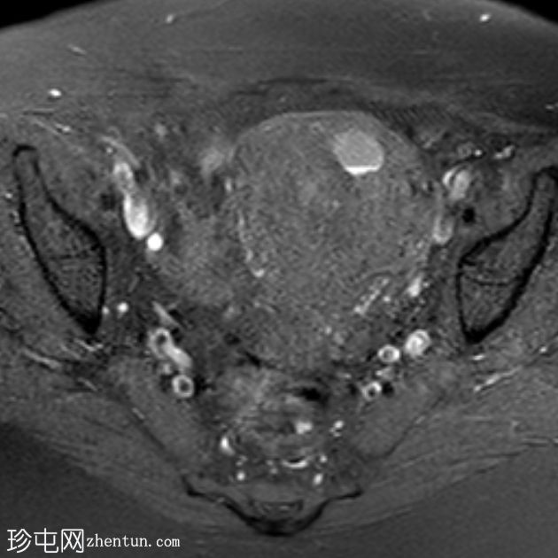 子宫囊性子宫腺肌病