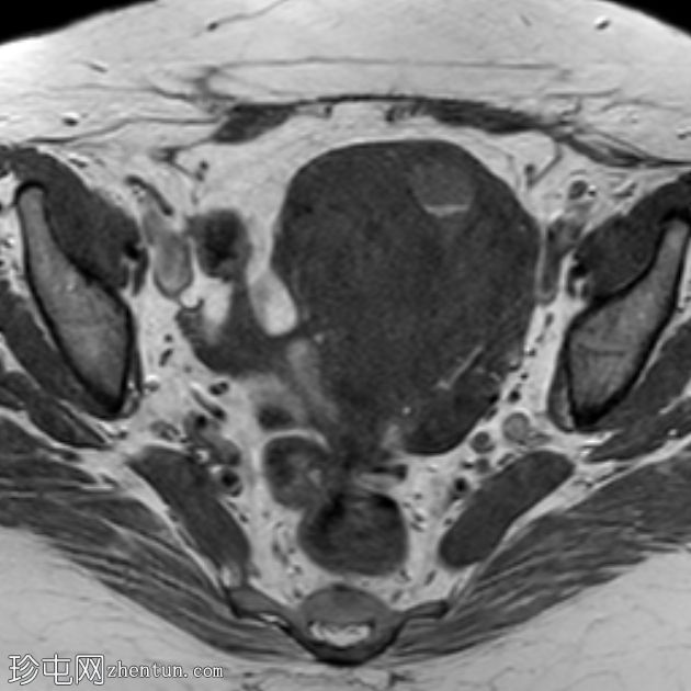 子宫囊性子宫腺肌病