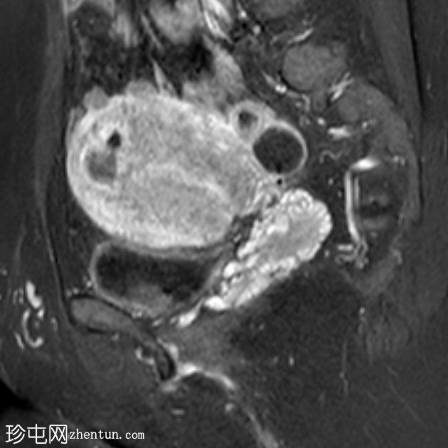 子宫囊性子宫腺肌病