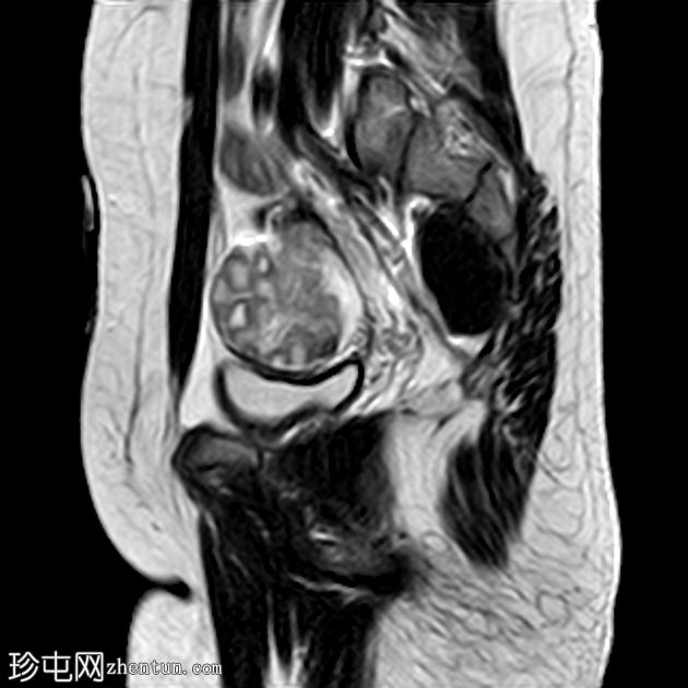 卵巢扭转并发卵巢冠囊肿