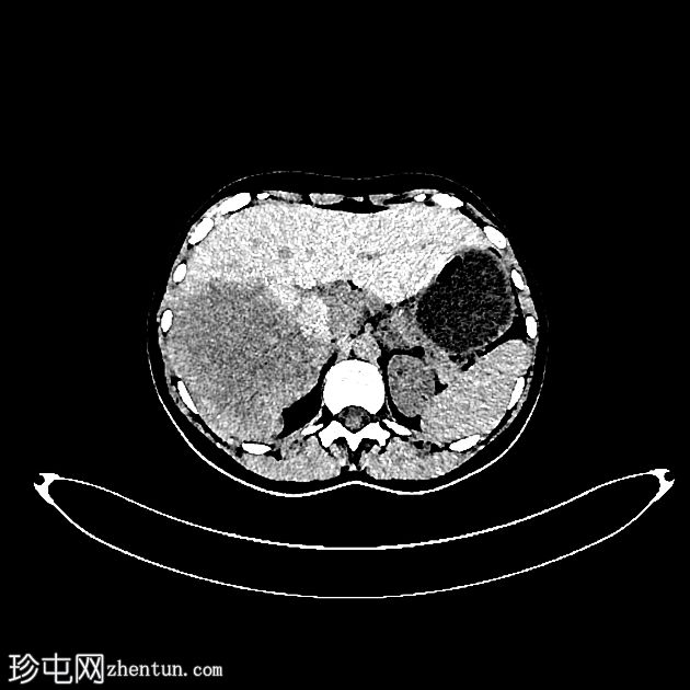 肝泡型包虫病