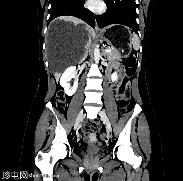 肝泡型包虫病