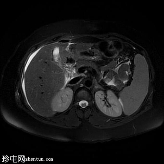 腹腔镜胆管损伤致胆源性腹膜炎