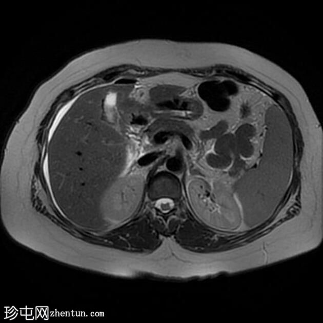 腹腔镜胆管损伤致胆源性腹膜炎