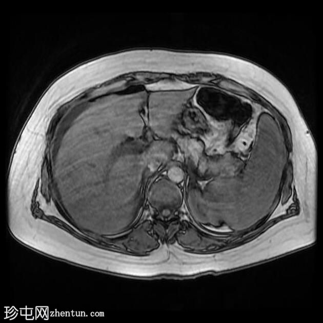 腹腔镜胆管损伤致胆源性腹膜炎