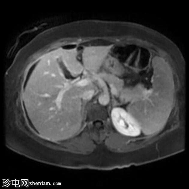 腹腔镜胆管损伤致胆源性腹膜炎