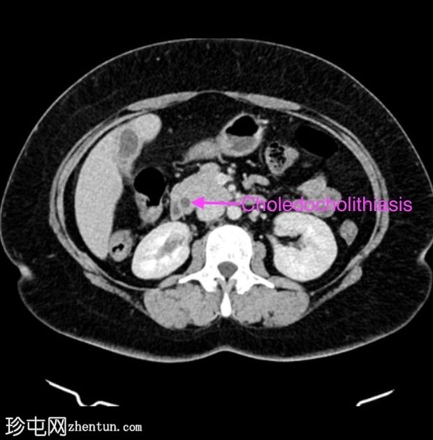 胆总管结石、胆管炎和门静脉血栓性静脉炎