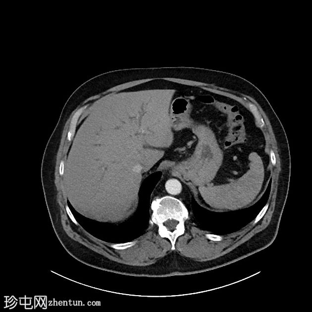 IgG4 相关自身免疫性胆管炎、胰腺炎和假肿瘤