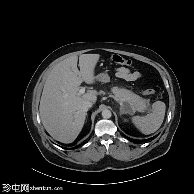 IgG4 相关自身免疫性胆管炎、胰腺炎和假肿瘤