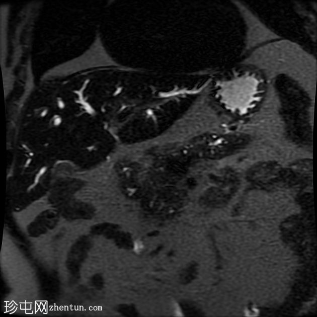 IgG4 相关自身免疫性胆管炎、胰腺炎和假肿瘤