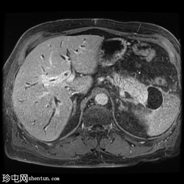 IgG4 相关自身免疫性胆管炎、胰腺炎和假肿瘤