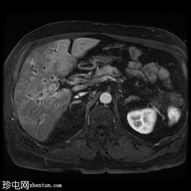 IgG4 相关自身免疫性胆管炎、胰腺炎和假肿瘤