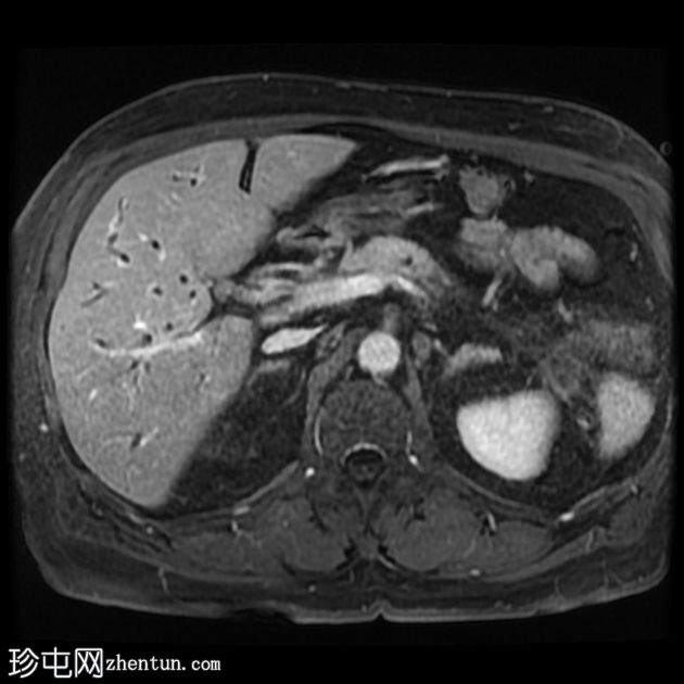 IgG4 相关自身免疫性胆管炎、胰腺炎和假肿瘤