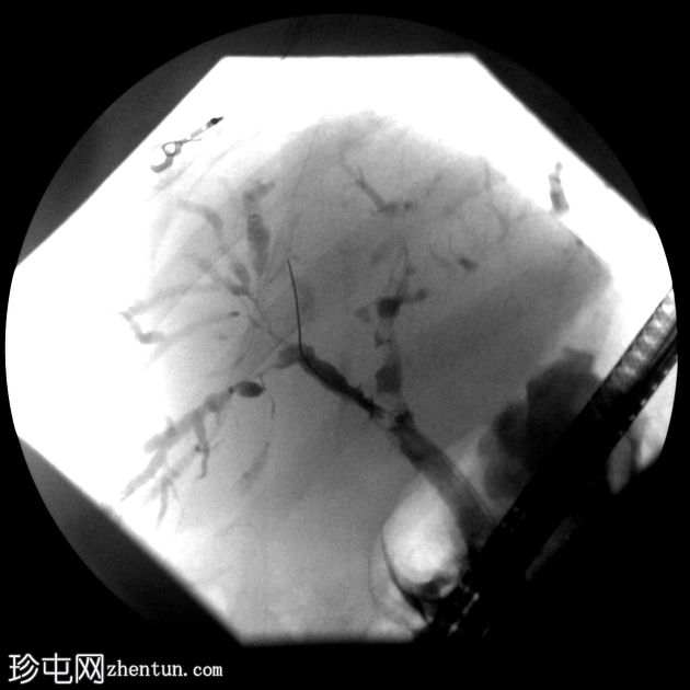 IgG4 相关自身免疫性胆管炎、胰腺炎和假肿瘤