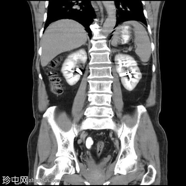 急性胆囊炎