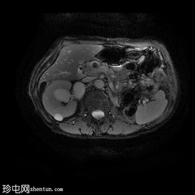 胆结石和胆总管结石