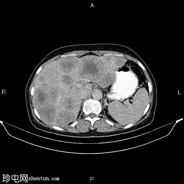 转移性升结肠腺癌