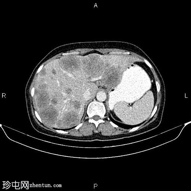 转移性升结肠腺癌