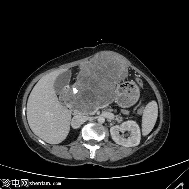 胰腺浆液性囊腺瘤