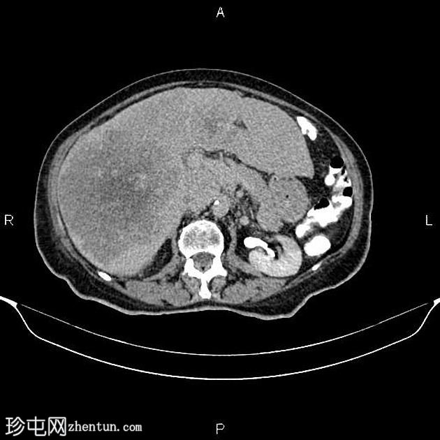 转移性乙状结肠腺癌