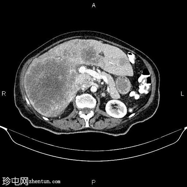 转移性乙状结肠腺癌