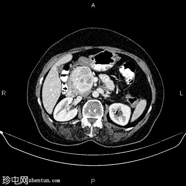 胰腺内分泌肿瘤