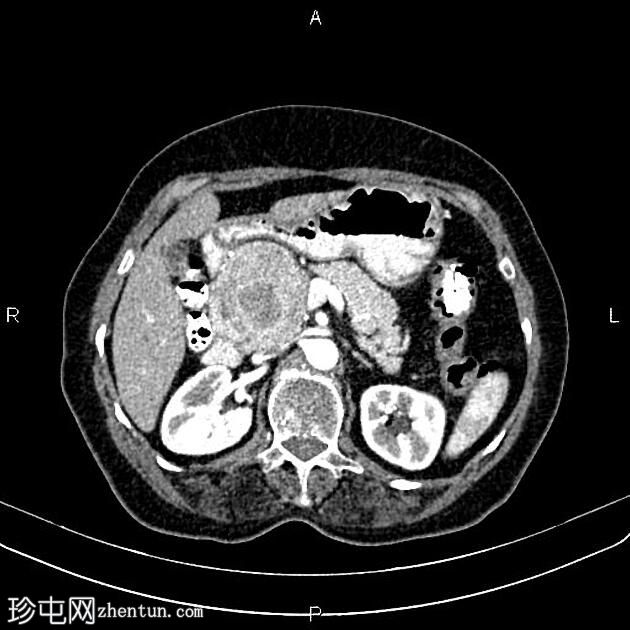 胰腺内分泌肿瘤