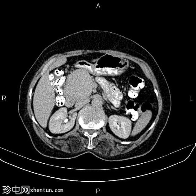 胰腺内分泌肿瘤