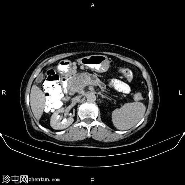 胰腺腺癌