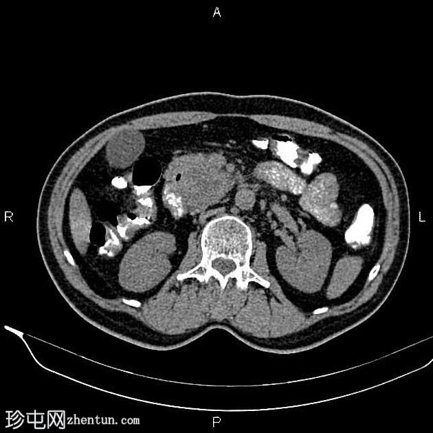 胰腺腺癌