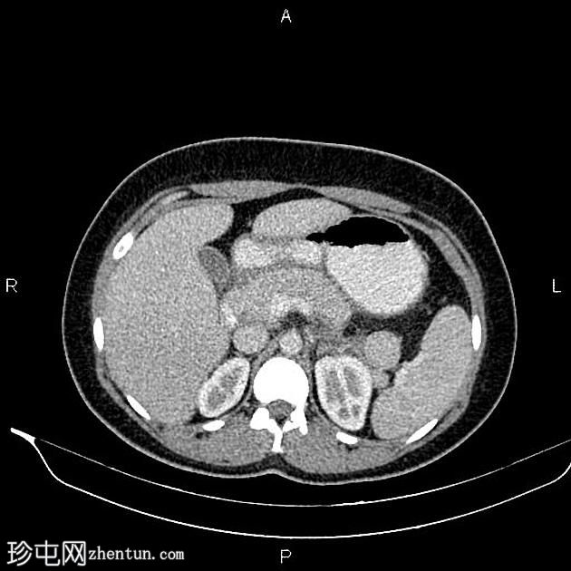 急性胰腺炎