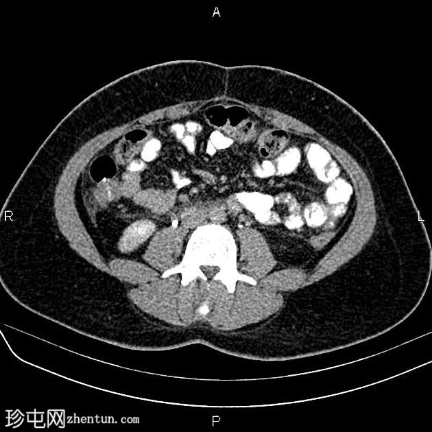 急性胰腺炎