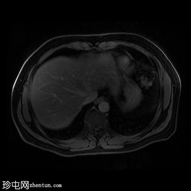 多灶性肝脂肪变性